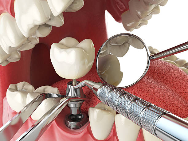 Best Emergency Tooth Extraction in New Waverly, TX